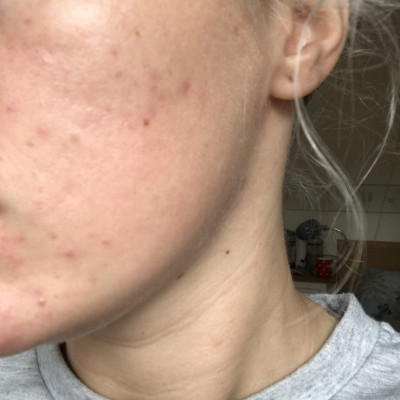 Danielle* - Acne Scar