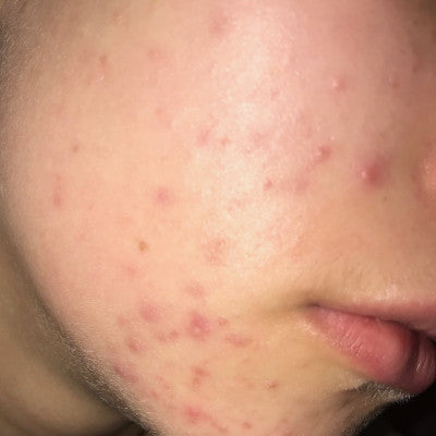 Olivia* - Acne scar