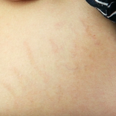 Beauty blogger, LittleMehrBlog * - Stretch Marks