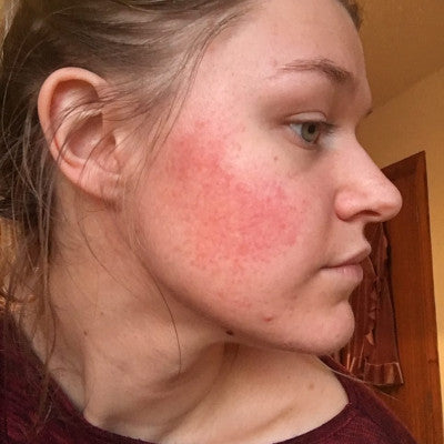 Nicole* - Rosacea